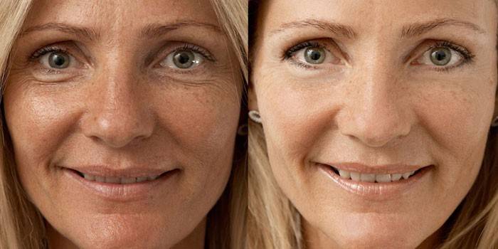Фото женщины до и после биоревитализации