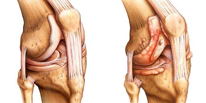 Здоровый и больной артритом коленный сустав