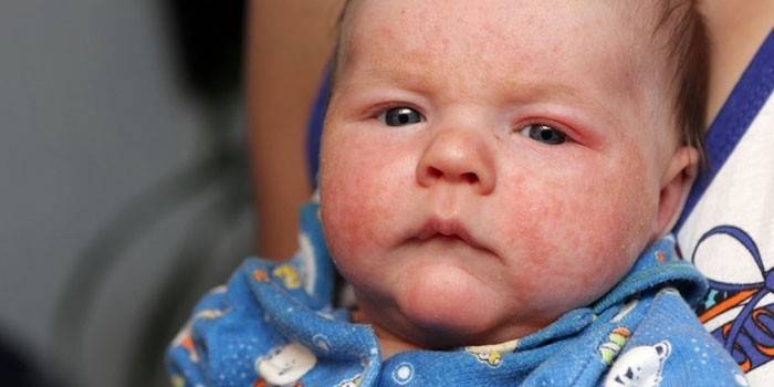 Атопический дерматит на лице у малыша