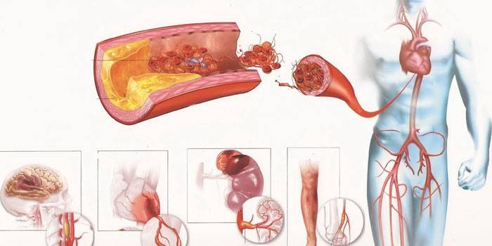 Атеросклероз сосудов различных органов человека