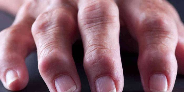 Ревматоидный артрит пальцев руки