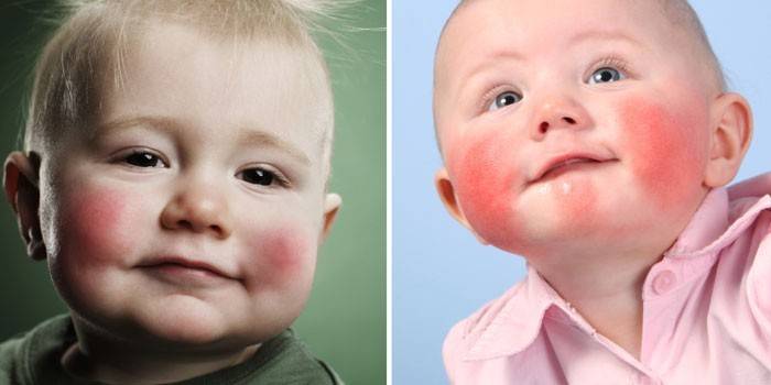 Проявления детского диатеза на щеках у малышей