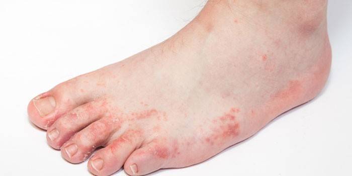 Проявления аллергического дерматита на ступне