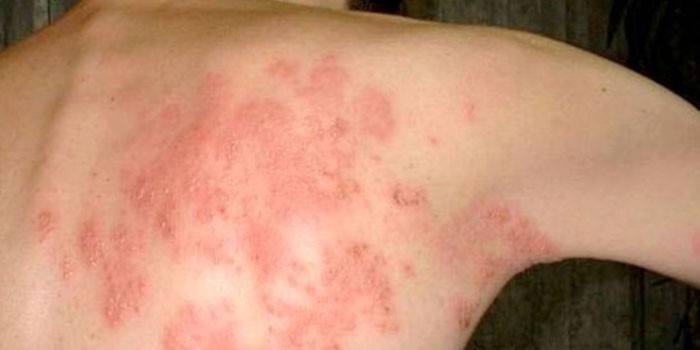 Проявление дерматомикоза кожи на спине у человека