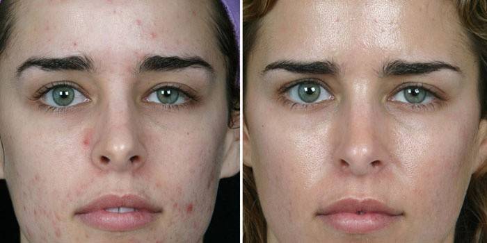 Кожа на лице девушки до и после механической чистки косметологом