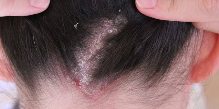 Себорейный дерматит волосистой части головы: лечение медикаментозное и народными методами, фото симптомов себореи на голове и причины возникновения