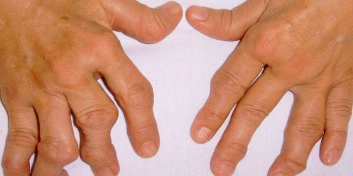 Ревматоидный артрит рук