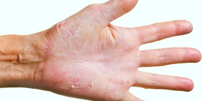 Как лечить грибковую инфекцию ногтей на руках? Как правильно подготовить ноготь к лечению. Чем лечат микоз в домашних условиях, лучшее средства народной медицины