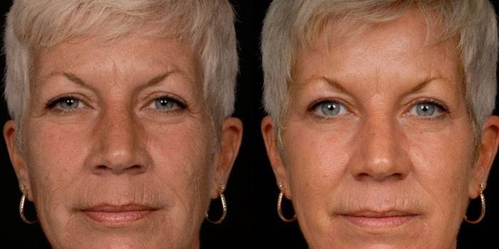 Фото женщины до и после карбокситерапии