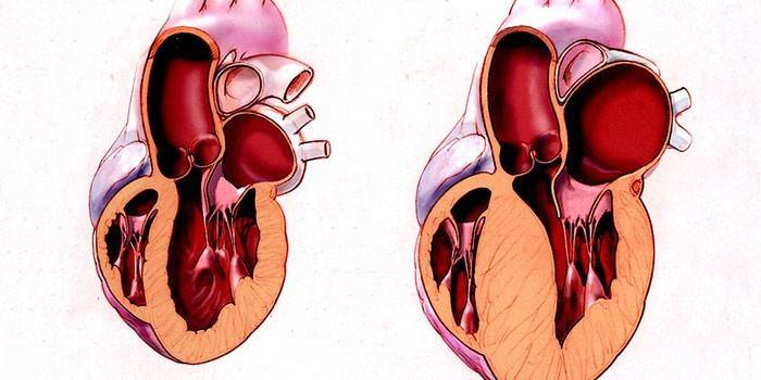 Схема здорового и больного сердца