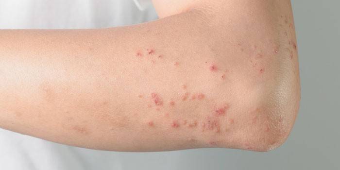Проявления аллергии на коже руки