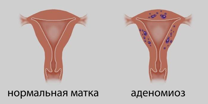 Нормальная матка и матка при аденомиозе