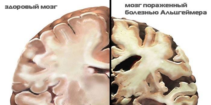 Сравнение здорового мозга и мозга пораженного болезнью Альцгеймера