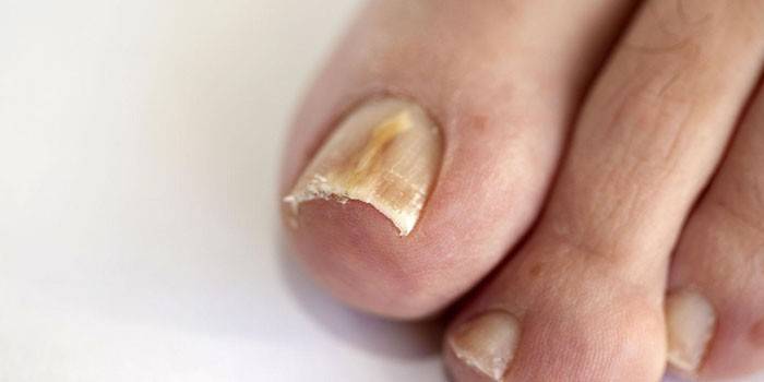 Атрофический грибок ногтя