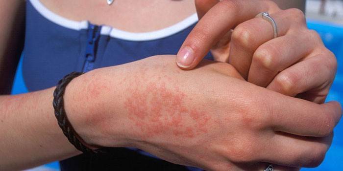 Проявление аллергической сыпи на коже руки