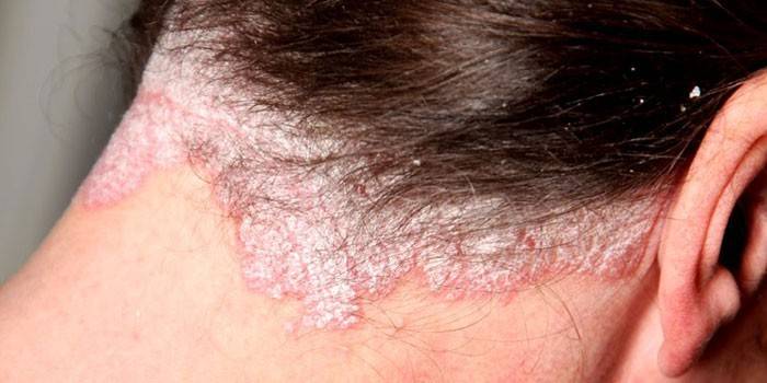 Себорейный дерматит волосистой части головы