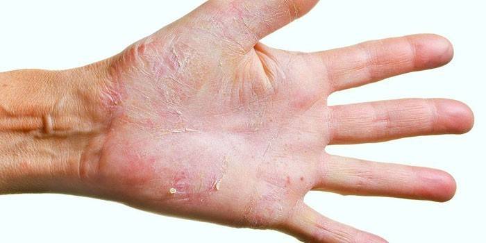 Основные причины грибка ногтей на руках. Быстрые и эффективные способы диагностики и лечения грибка ногтей на руках