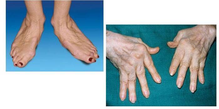 Ревматоидный артрит ног и рук