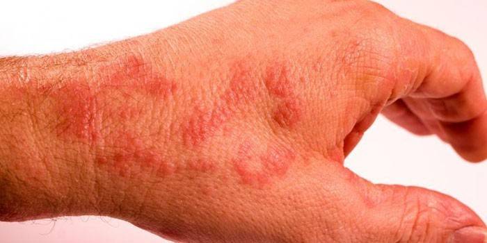 Проявления сыпи на коже рук