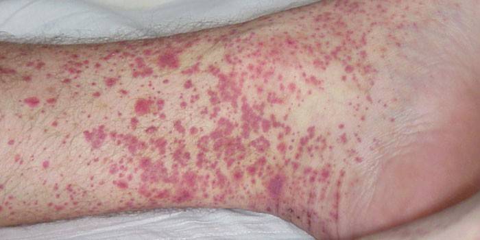 Проявление геморрагической лихорадки на коже ноги