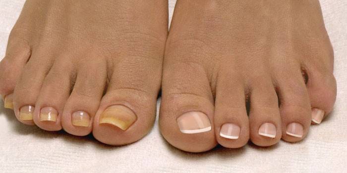 Пораженные грибком ногти на ноге и здоровые ноги