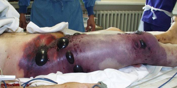 Мужчина с газовой гангреной ноги на операционном столе