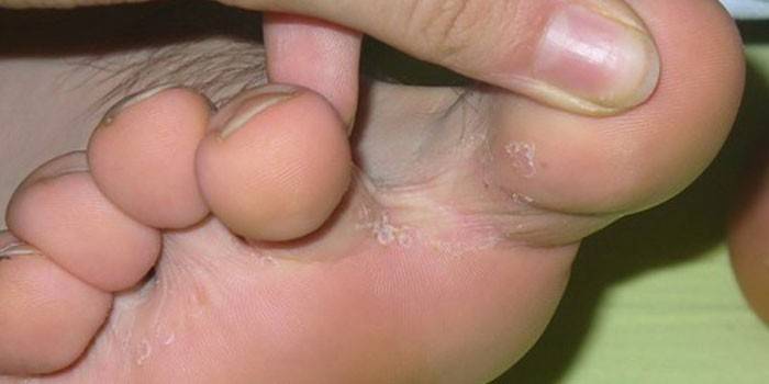 Проявления грибка кожи между пальцами на ноге