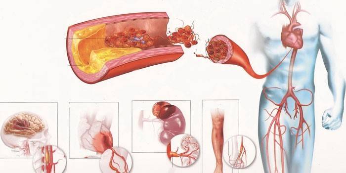 Схема атеросклероза аорты различных органов человека
