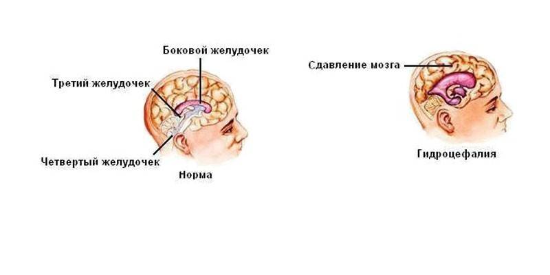 Гипертензивная энцефалопатия