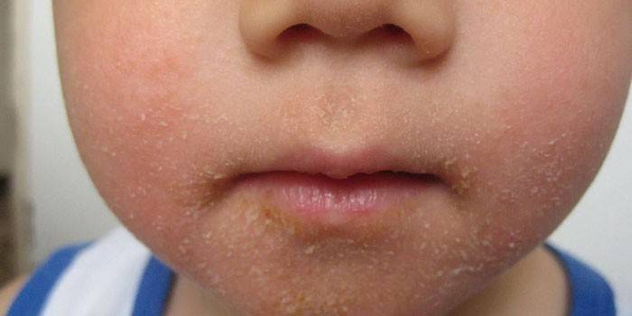 Стрептодермия на лице у ребенка