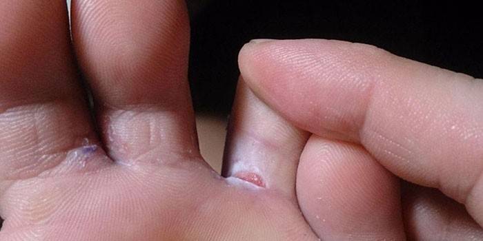 Трещины на пальцах ног