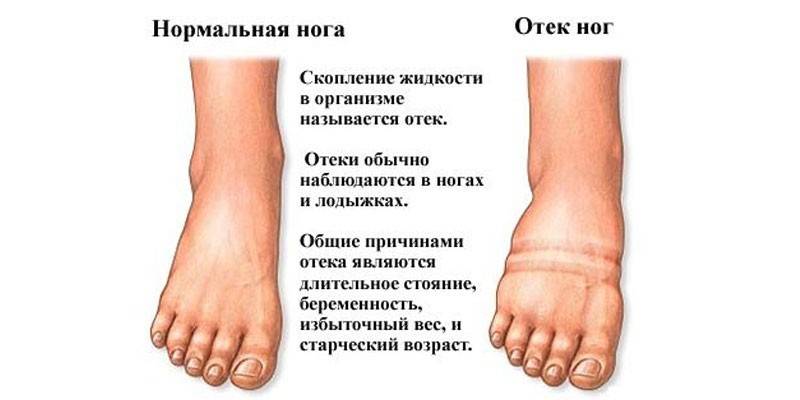 Причины отеков ног