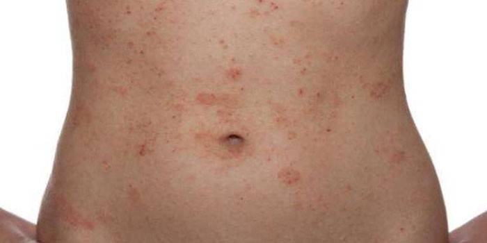 Аллергический дерматит на теле