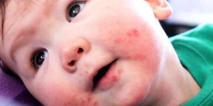 Энтеровирусная сыпь на лице у ребенка