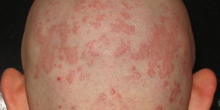 Проявления себорейного дерматита кожи головы у мужчины