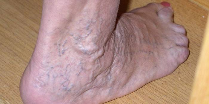 Глубокий тромбоз вен на ноге