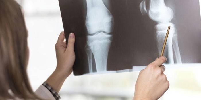 Медик изучает рентгеновский снимок коленного сустава