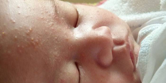 Проявления неонатальной сыпи на лице у ребенка