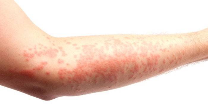 Аллергическая реакция на коже руки