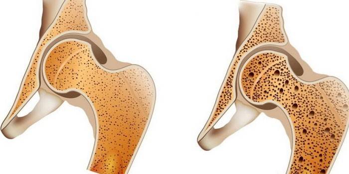 Нормальная кость (слева) и остеопороз
