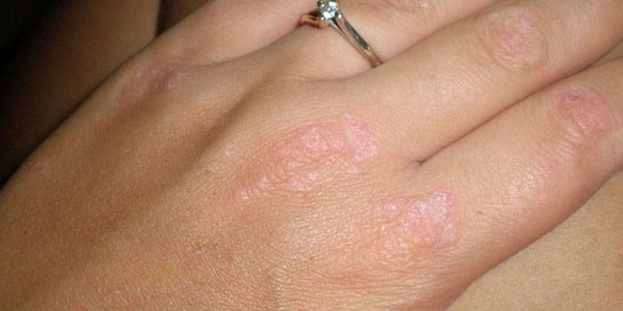 Проявление псориаза на коже рук у женщины