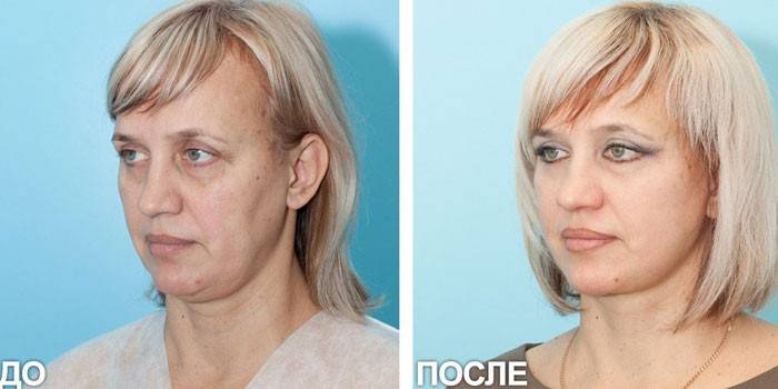 Фото женщины до и после СМАС-лифтинга