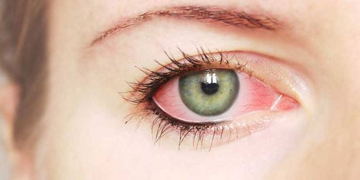 Покраснение белка глаза