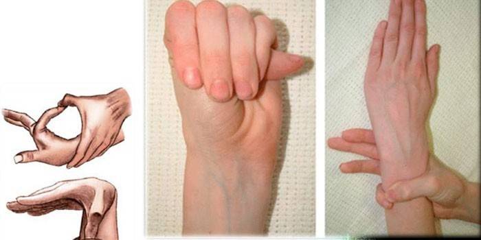 Признаки синдрома паучьих пальцев