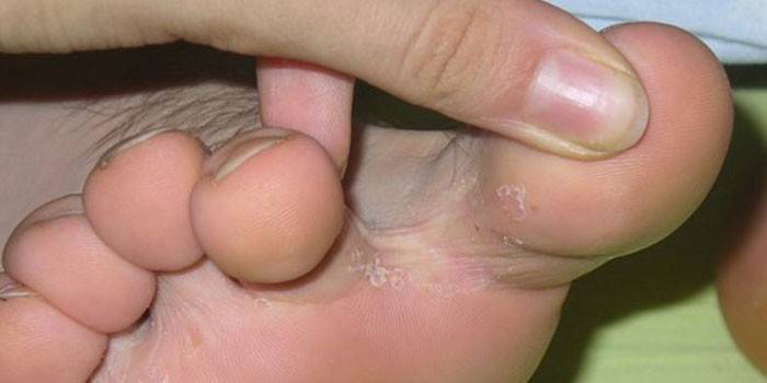 Трещины между пальцев ног