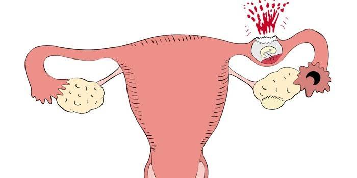 Внематочная беременность в маточной трубе
