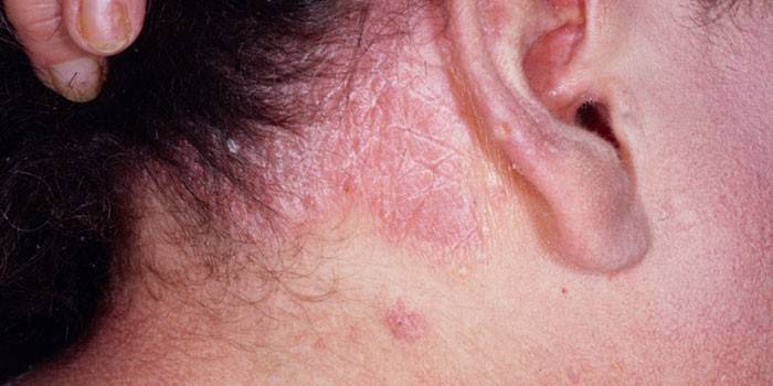 Себорейный дерматит за ухом