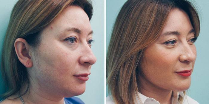 Женщина до и после инъекций липолитиков
