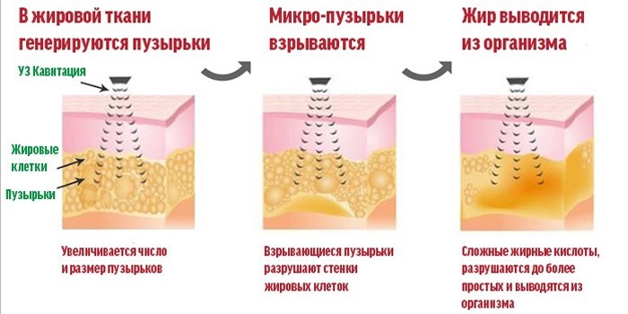 Принцип процедуры Кавитация