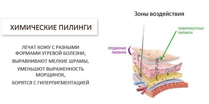 Зоны воздействия химических пилингов